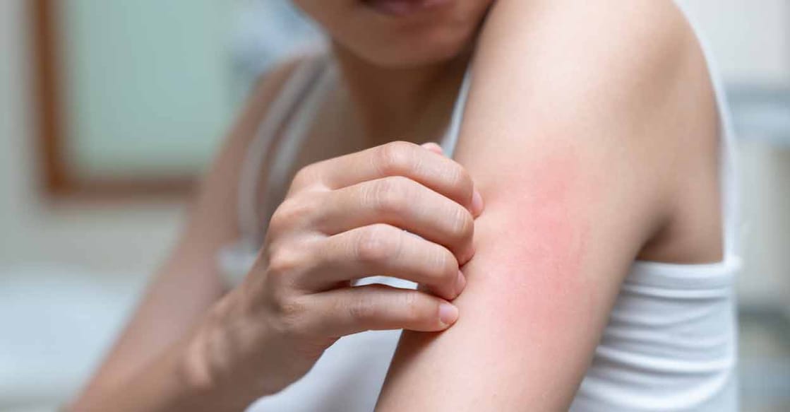  Dr B Padmakumar, Principal of the Medical College, Alappuzha, explains the difference between food poisoning and allergies. Photo: iStock/Nuttawan Jayawan