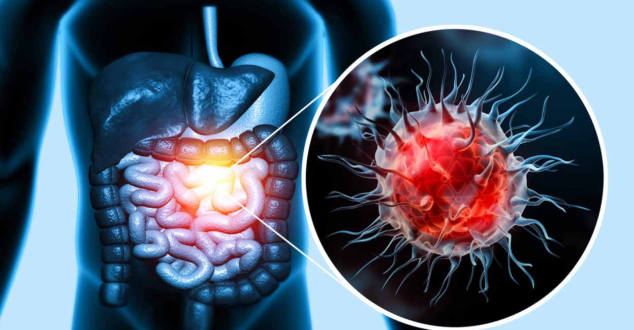 Early Detection is Key in Treating Colon Cancer: Doctor E...