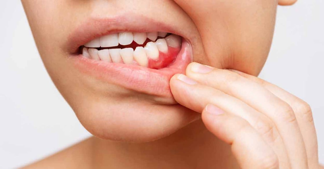 Bleeding gums are the number one symptom of the gum disease called gingivitis. Photo: iStock/Marina Demeshko