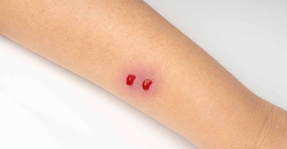 There is no need to catch a snake after a snakebite and carry it in bottles to hospitals, like many try to do. Photo: Shutterstock/Ermak Oksana