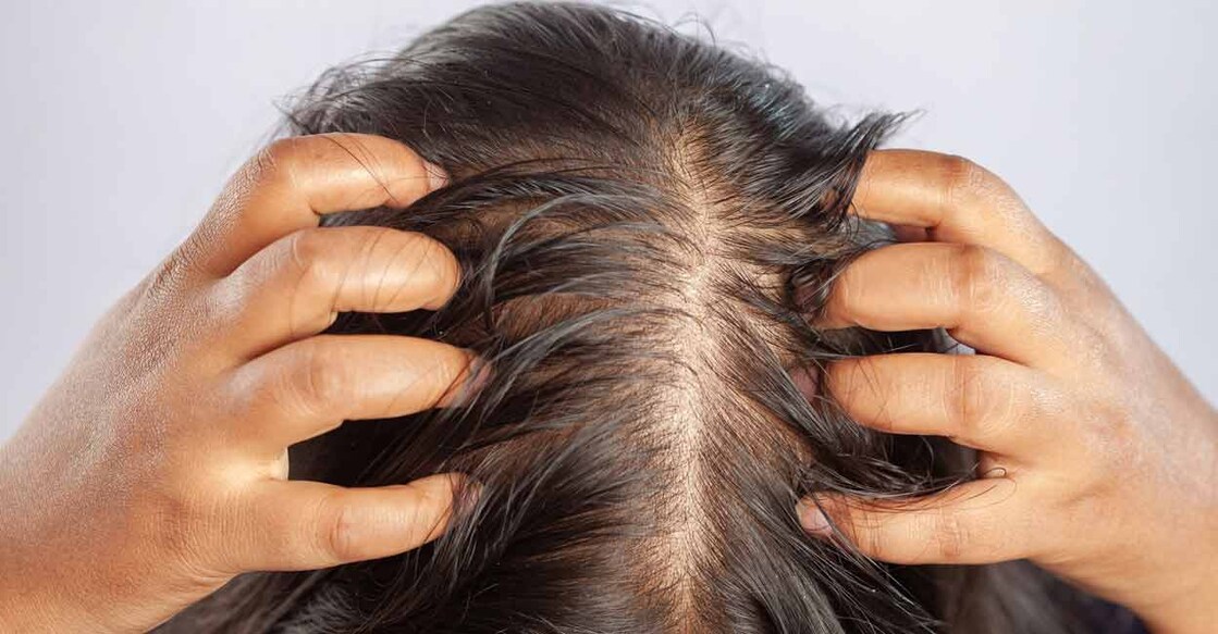 Hair loss is a key symptom of lupus. Photo: iStock/Dharmapada Behera