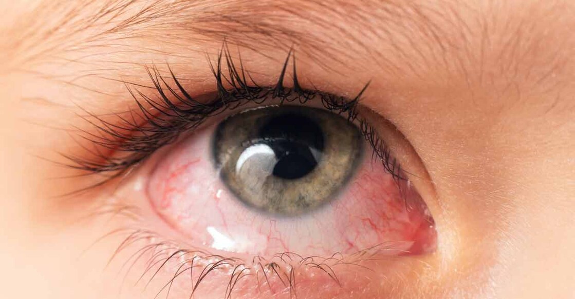 Conjunctivitis may easily spread from one person to another. Photo: Shutterstock/Afanasiev Andrii