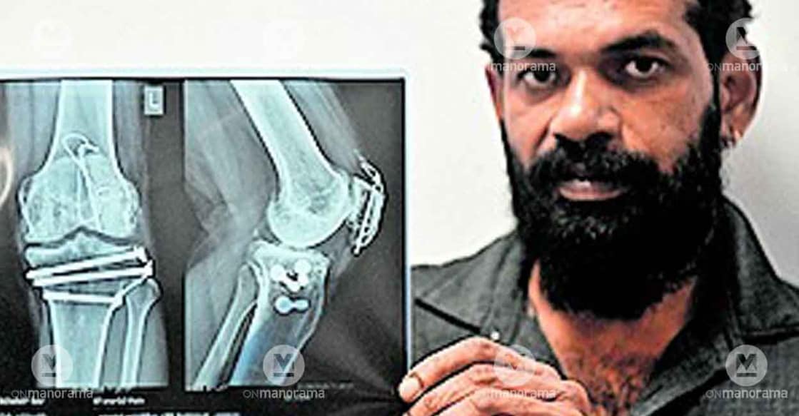 rameeraj-leg-surgery-xray rameeraj-leg-surgery-xray