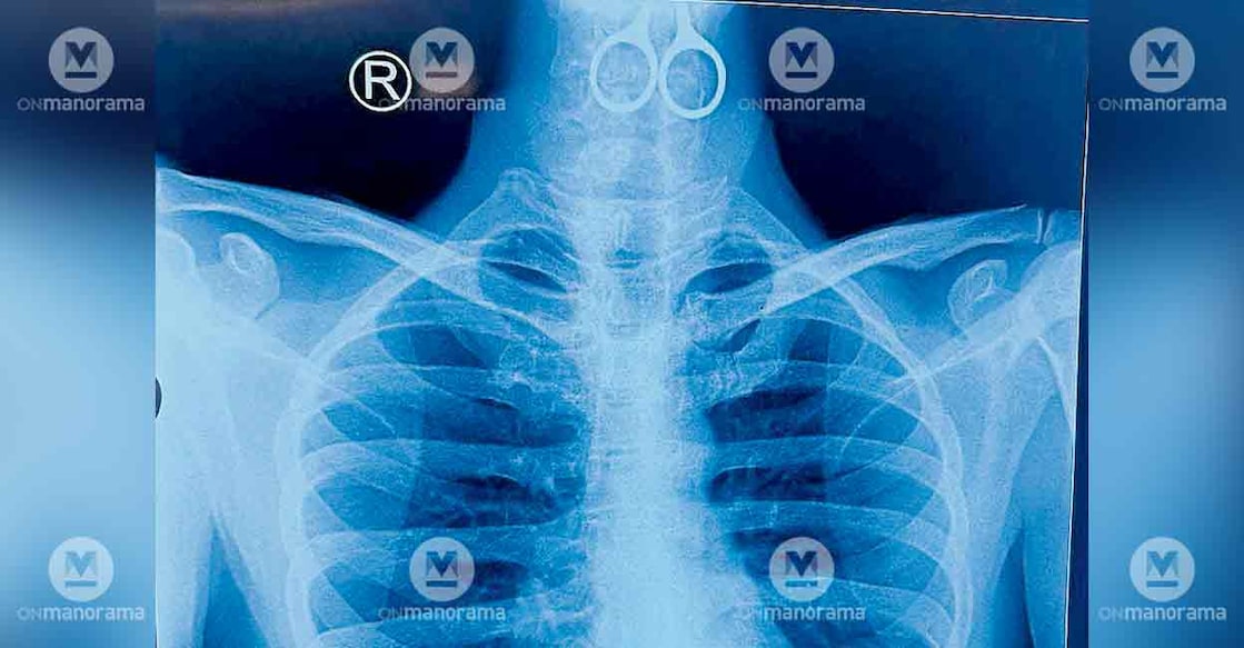 x-ray-scissors-surgery