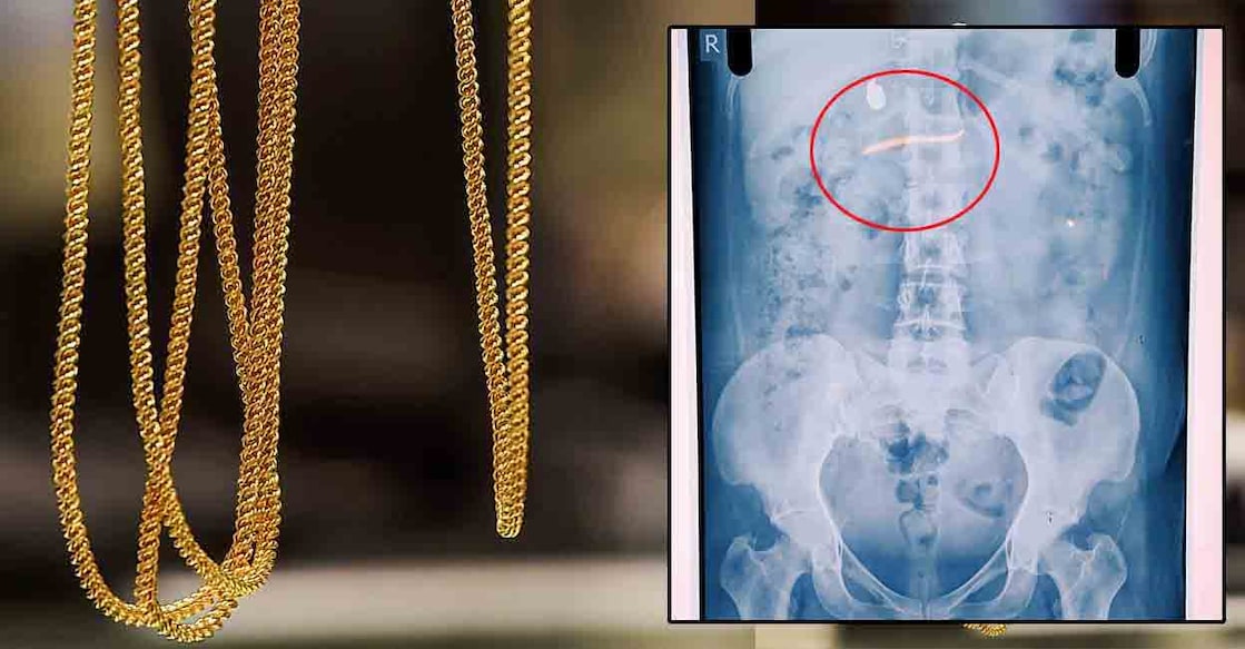 X-ray image of the woman in police custody. Photo: Manorama