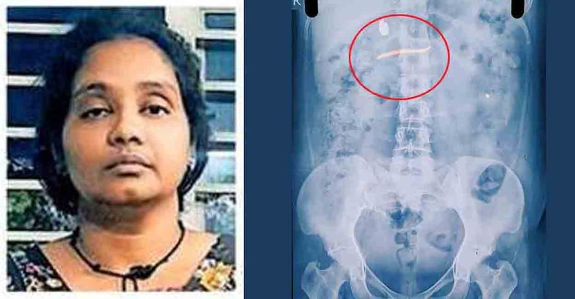 Smeena, swallowed gold chain shown in X-ray. Photo: Manorama