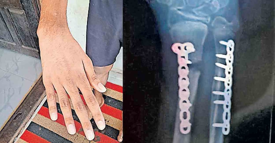 The bent arm of the Class 9 student after treatment at Konni Medical College (L) and an X-ray showing the fracture in his arm even after putting a bolt. Photo: Manorama
