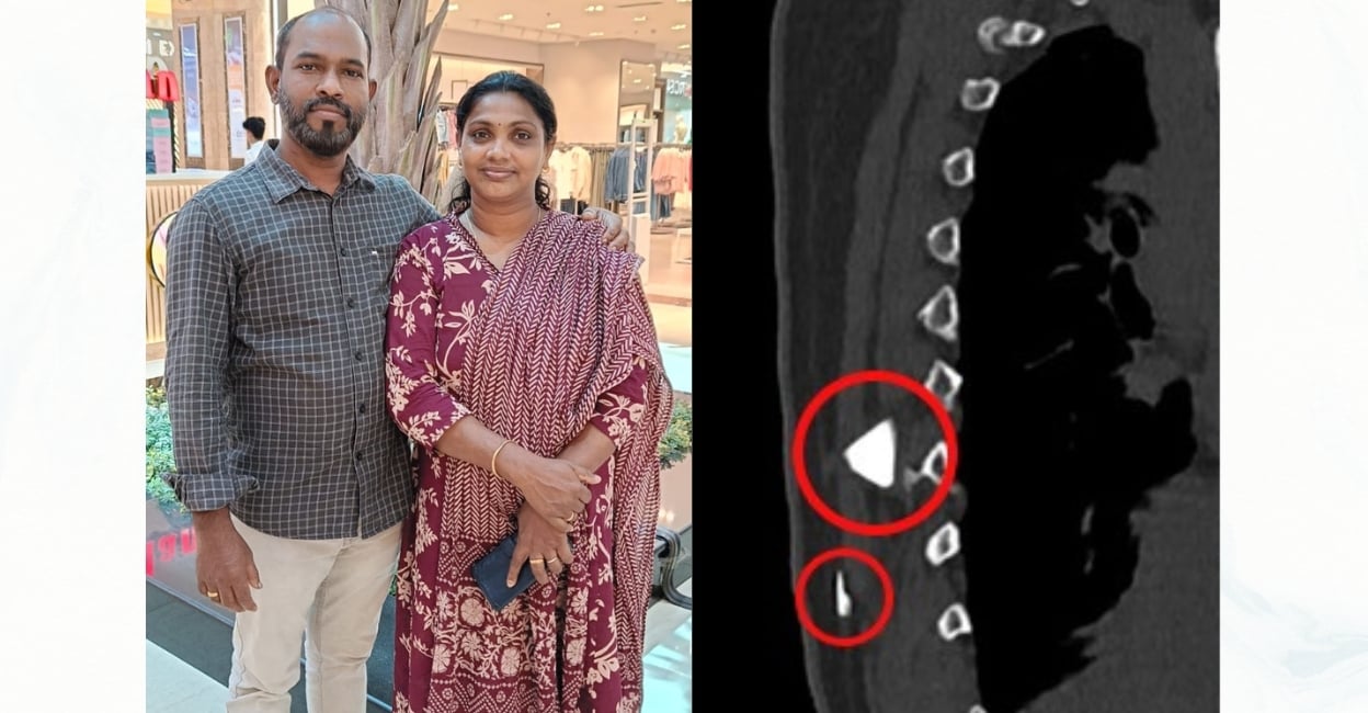 Glass shard hidden in Kerala woman’s back removed after 12 years of mystery and pain