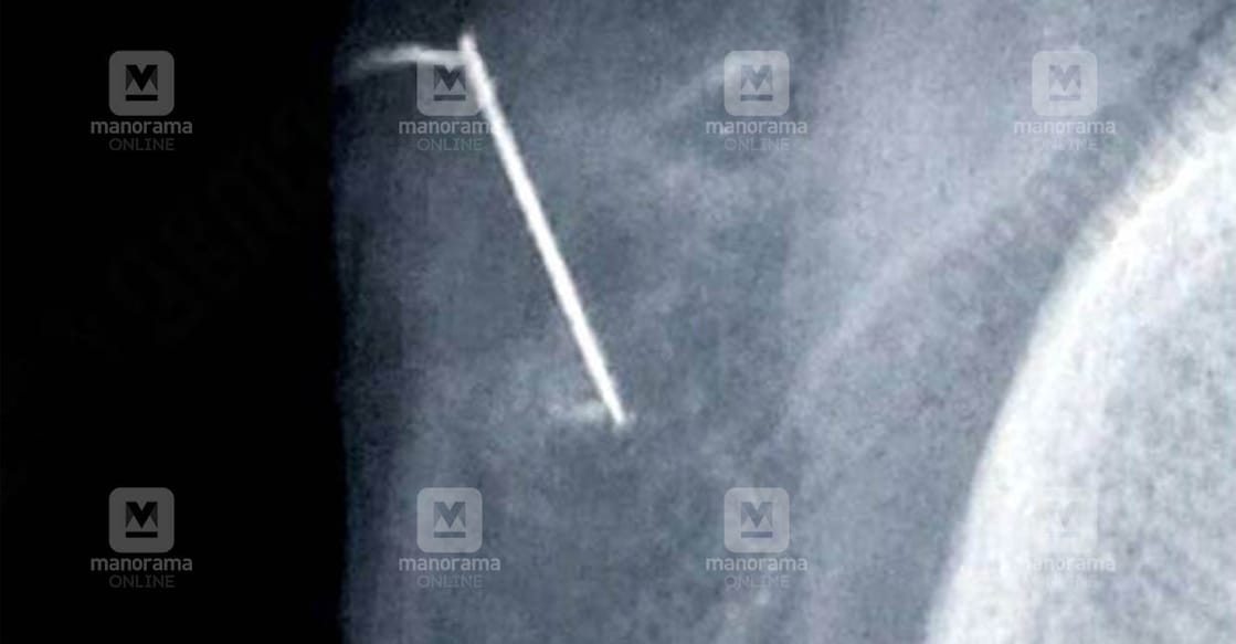 An X-ray showing the needle inside the child's stomach. Photo: Manorama Online