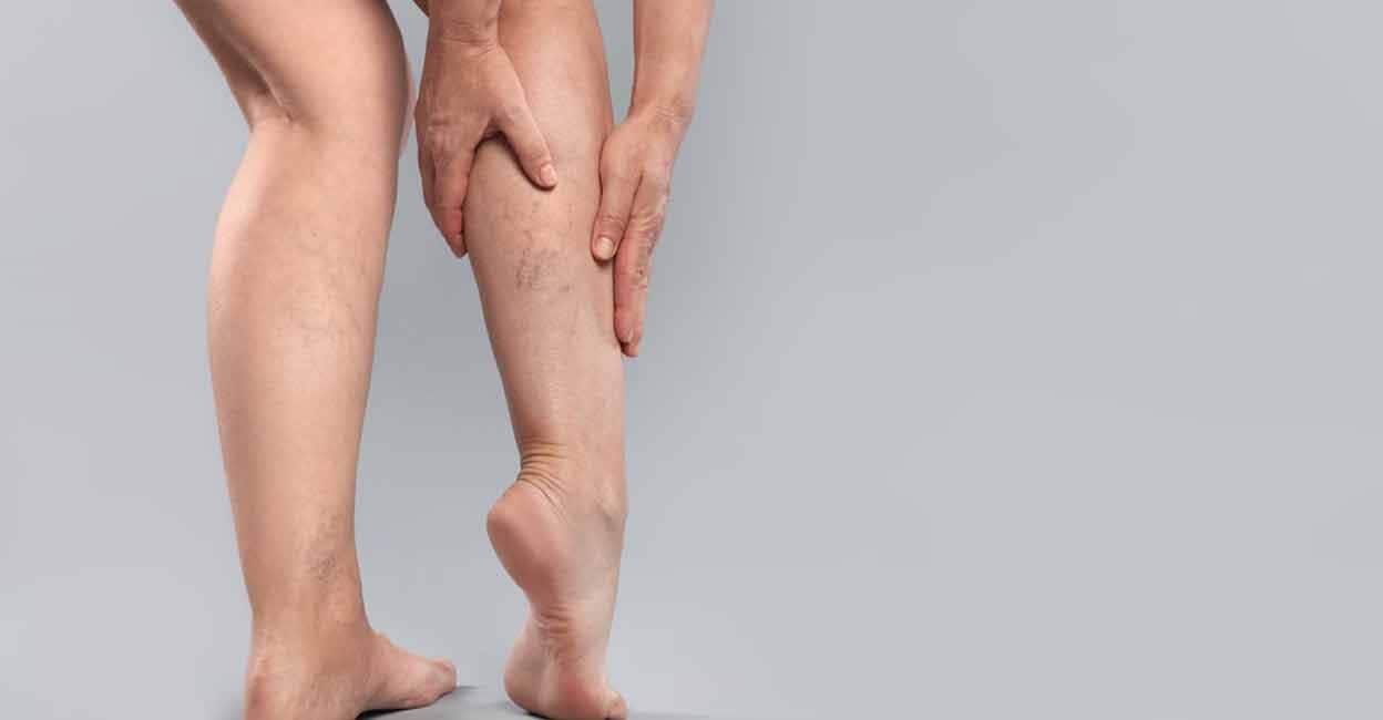 Healing Through Yoga: Poses to Improve Blood Circulation and Ease Varicose Veins article image