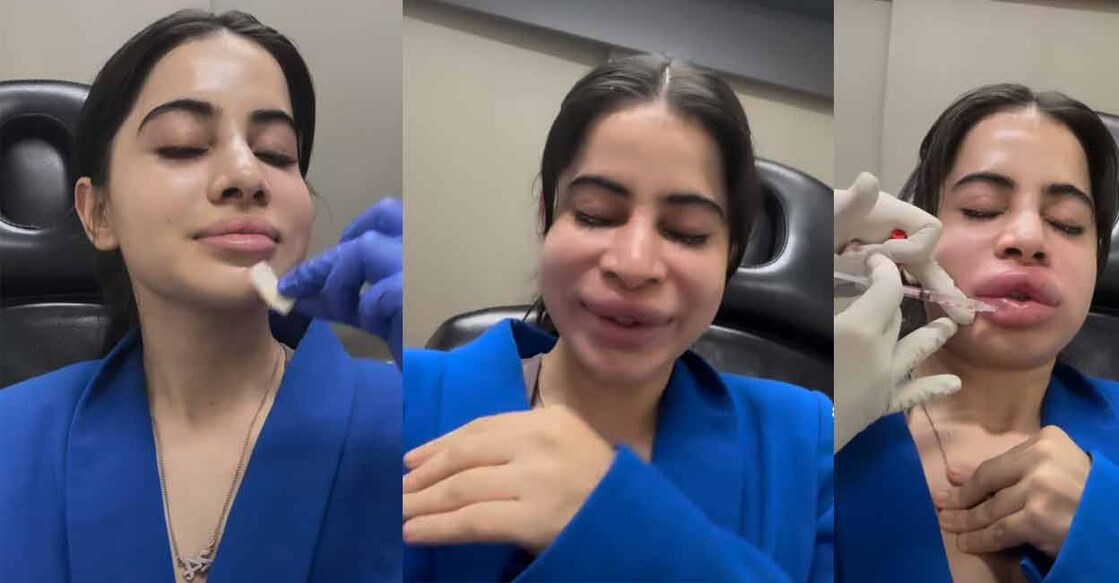 Uorfi shared a video in which she can be seen undergoing the lip filler procedure. Photo: Instagram/@urf7i