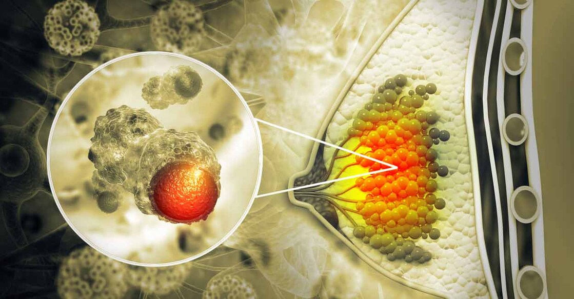 Malabar Cancer Care Society launched the Breast Cancer Brigade Project in 2017.      Photo: iStock/Mohammed Haneefa Nizamudeen