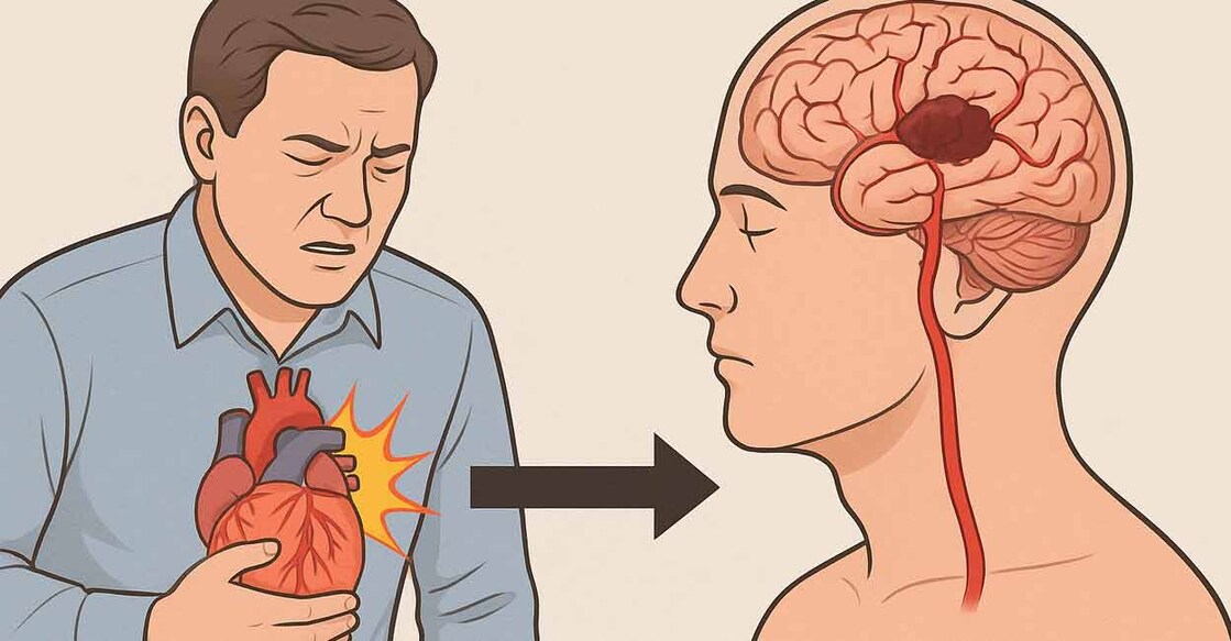 The risk factors for both heart attacks and strokes are the same. AI Generated image