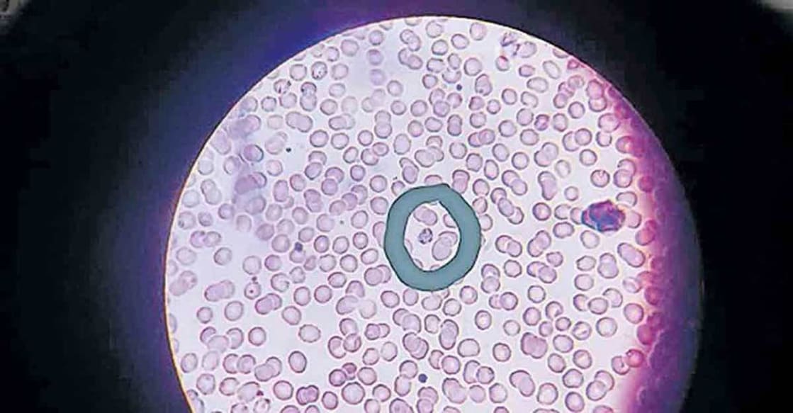 Rare malaria parasite detected in Kozhikode
