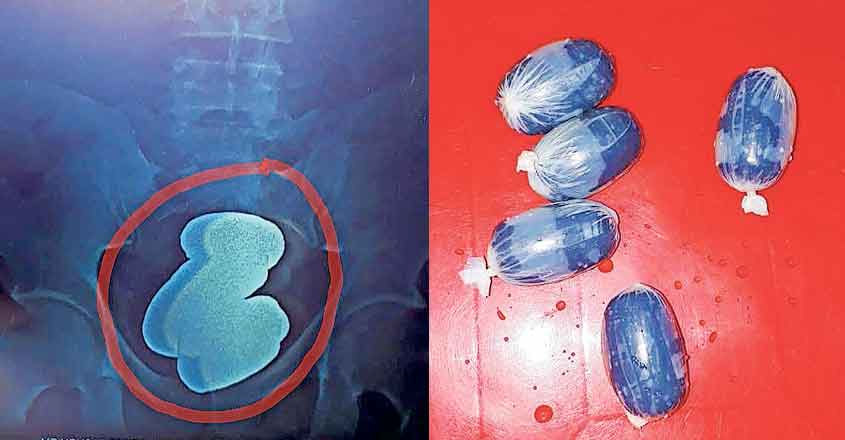 Here is how gold is smuggled by hiding it inside the human body