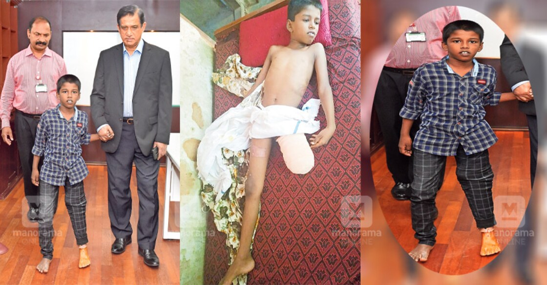 Artificial leg gives a new lease of life for boy 