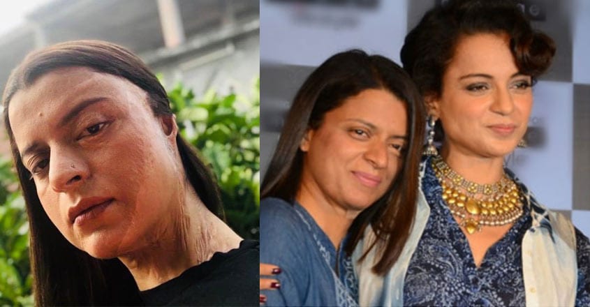 Kangana's sister Rangoli on horrifying acid attack: 54 surgeries and 5 ...