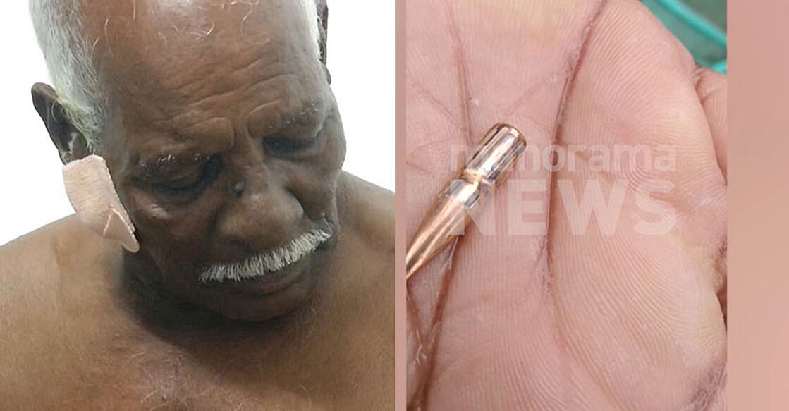 Fisherman Sebastian, who was shot at Fort Kochi; the stray bullet. Photo: Manorama News