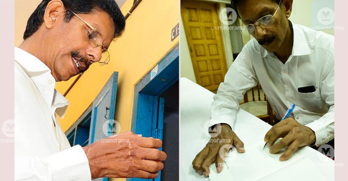 Scars of the attack are seen on the right hand of TJ Joseph. File photos: Manorama