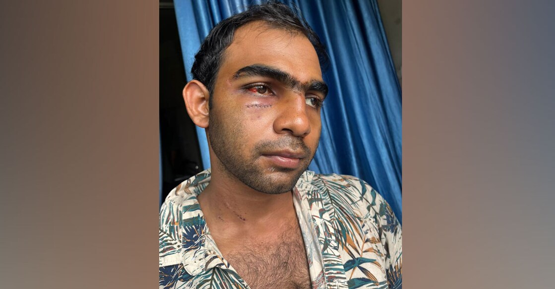 jaseem-injuries-koduvally Mohammed Jaseem shows his injuries. Photo: Special arrangement