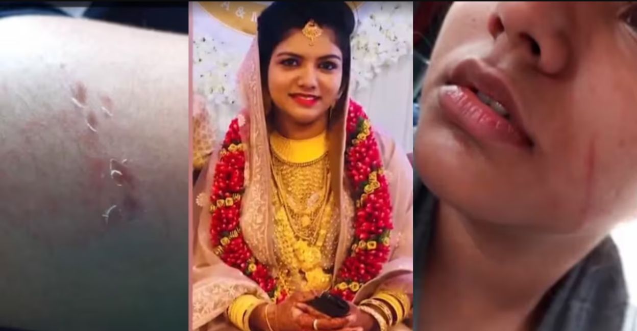 Shahana Shaji (centre); pictures of the bruises inflicted on her by her husband's family, which were made public by her relatives. Photo: Manorama Online