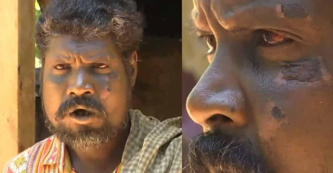 Babu says he is unable to eat due to the injuries. Photos: Screenshot/Manorama News