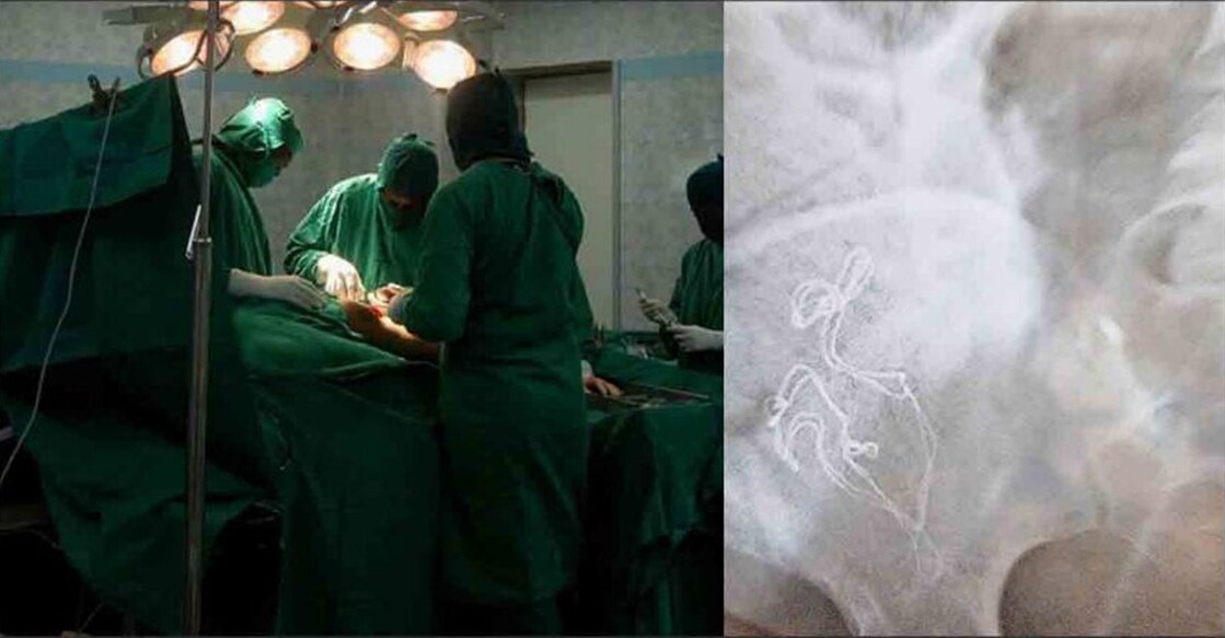 Representational Image (left) and cotton mops found during Chinju Raj's scan (right). Photo: Manorama Online