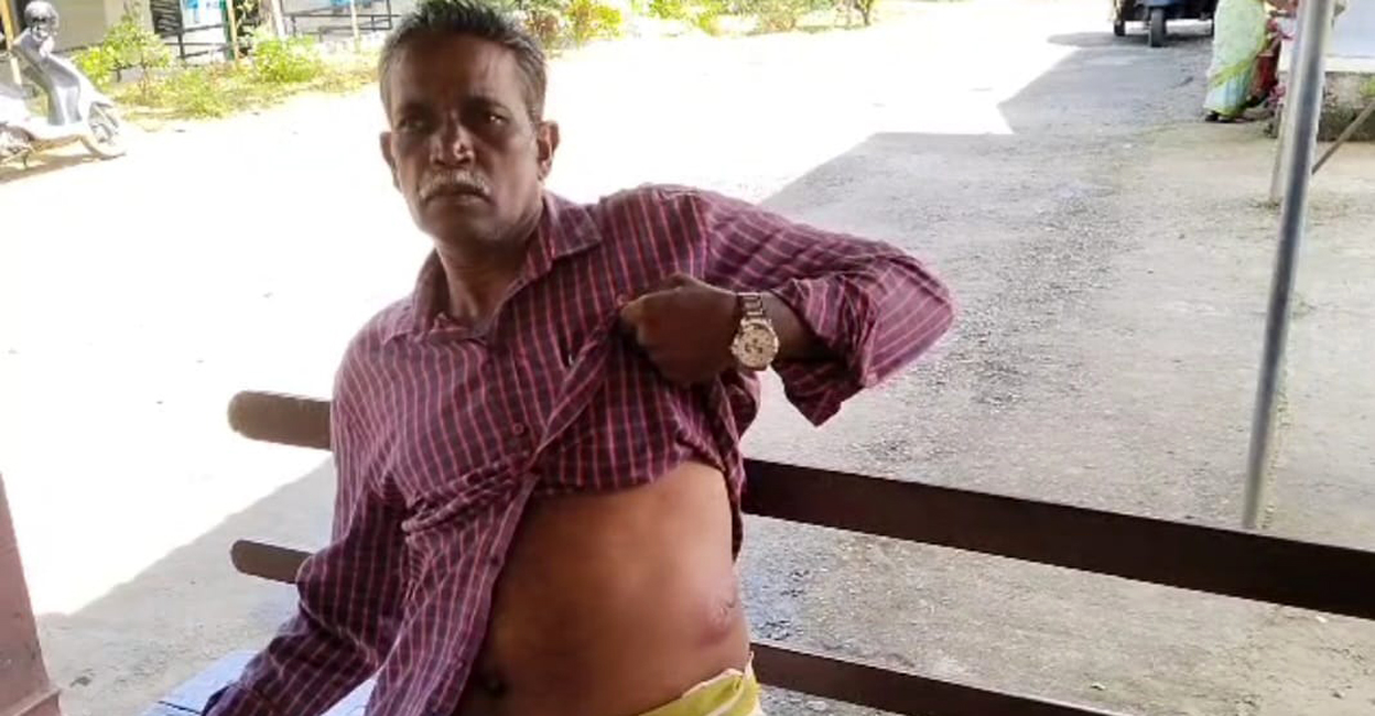 Puthanveetil K Selvaraj shows his injuries from the wild boar attack. Photo: Special arrangement