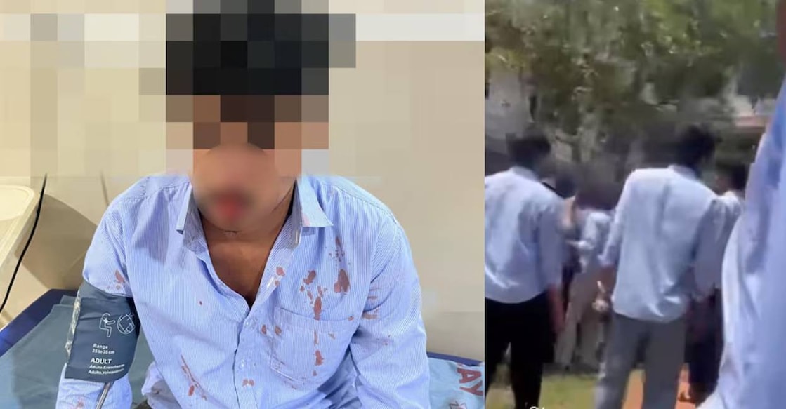 Adin Abdulla, a first-year B.Tech (Electronics) student, sustained a serious injury to his nose. Photo: Manorama
