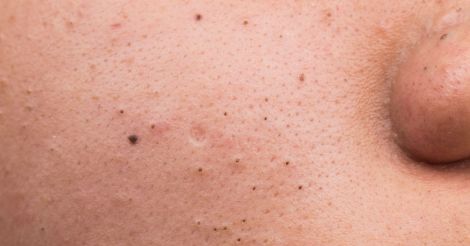 Pop Pop! Stop popping blackheads and try out these simple home remedies