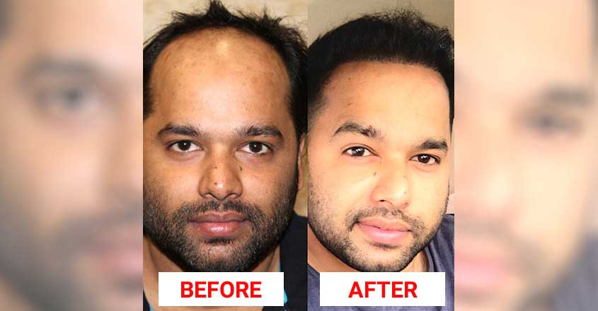 With solution to baldness, this Thiruvalla hospital is a success story |  Lifestyle Beauty | English