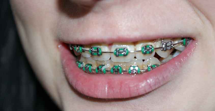 Braces. (File Photo: IANS) Braces. (File Photo: IANS)