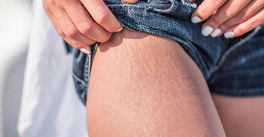 How to cover stretch marks with makeup