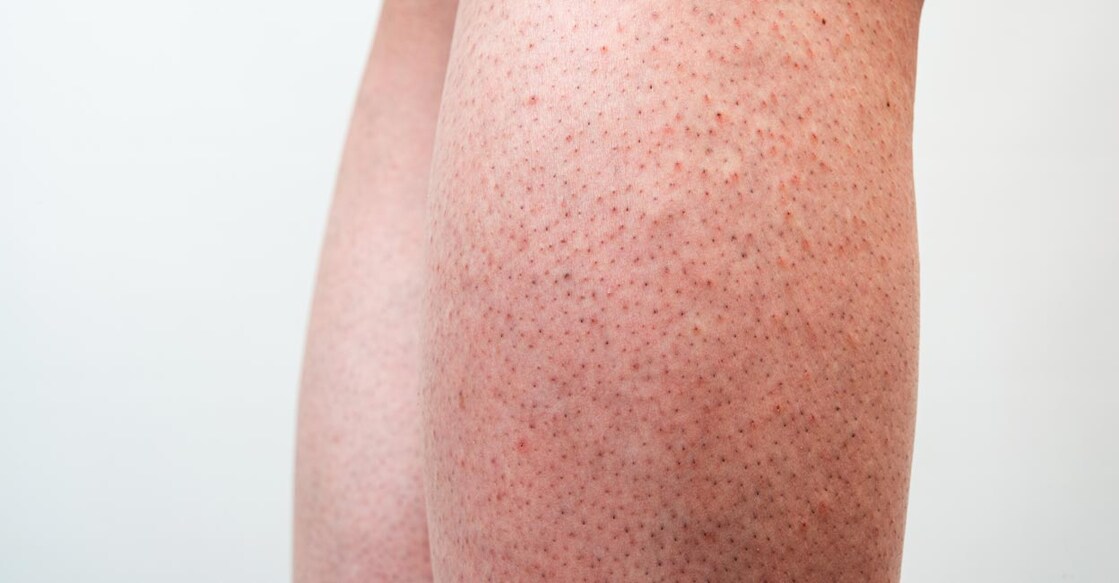 Strawberry legs: Shutterstock/Taro_since2017