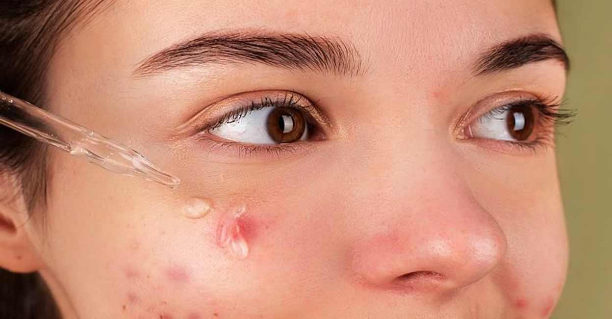 Warts are unpleasant and unattractive skin conditions. Photo: IANS