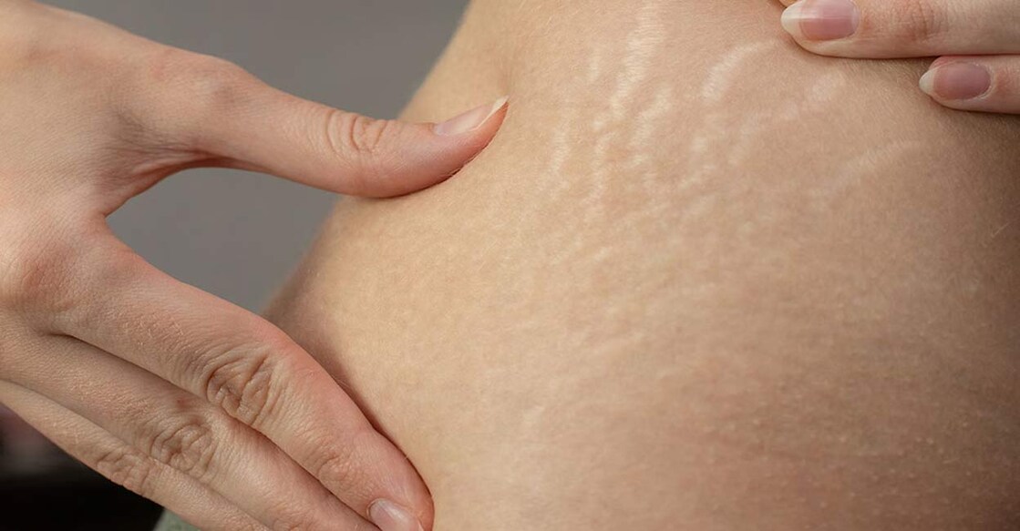 Stretch marks appear on the skin when the body weight increases and decreases suddenly. Photo: Epov Dmitry/Shutterstock