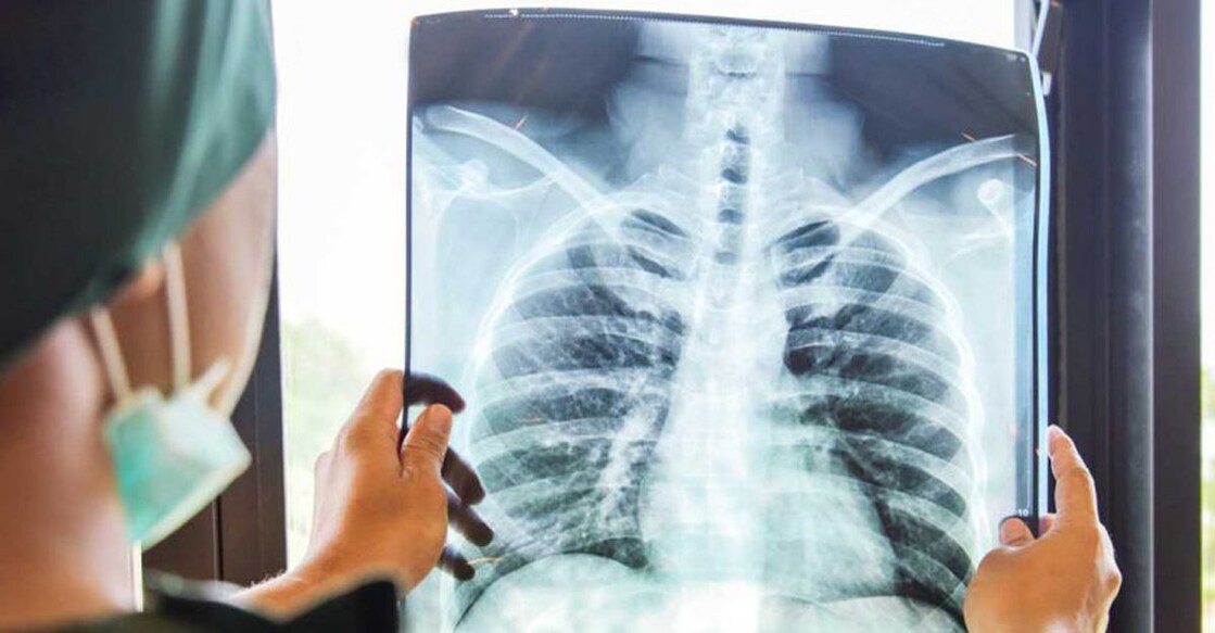 x-ray of lungs