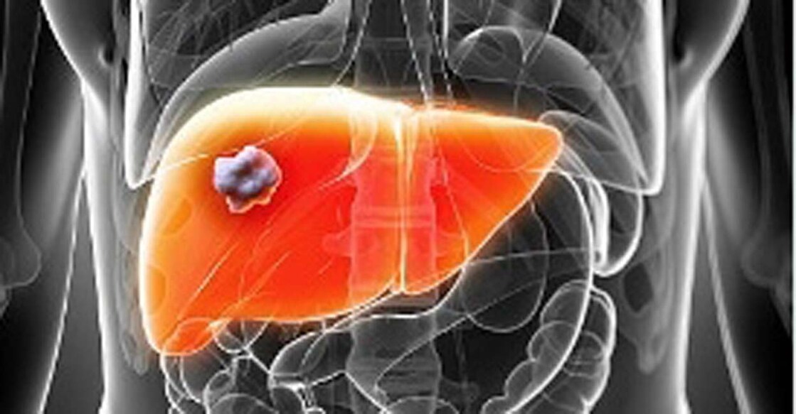 Liver abscesses