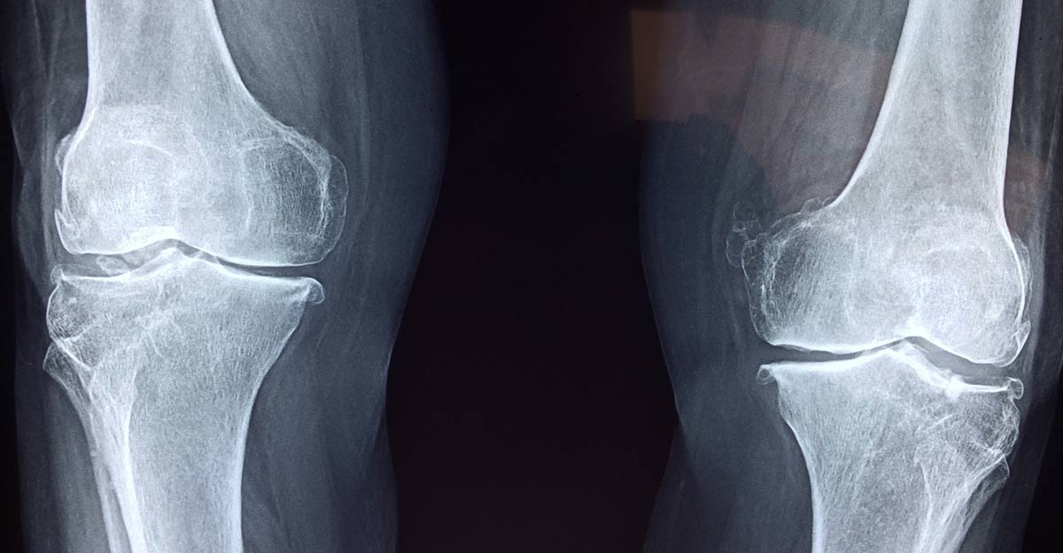 Knee osteoarthritis