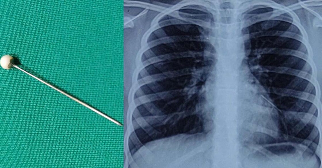 Metal pin removed from chest