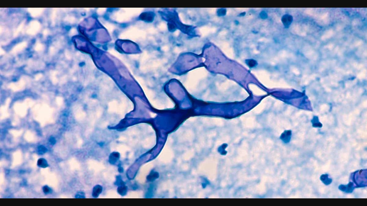 Explained What Is Black Fungus And How Dangerous It Is For Covid 19 Patients Manorama English
