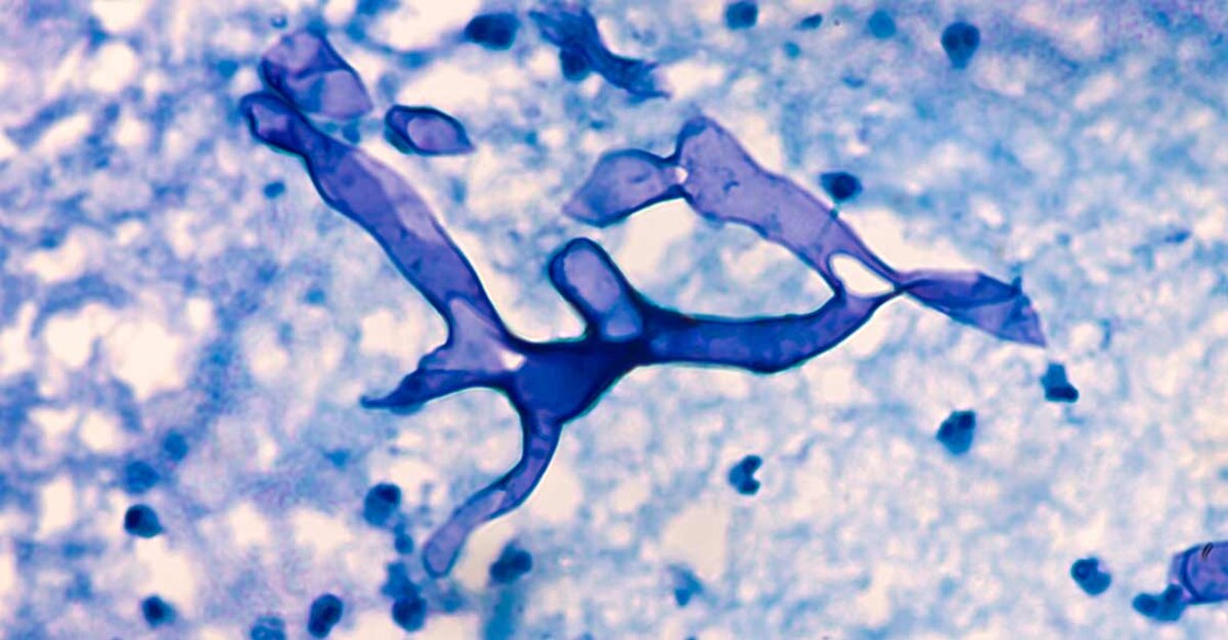 Broad, wide-angle non-septate hyphae of the fungus Mucor, from the paranasal sinus of a patient with diabetes mellitus. Modified giemsa stain of frozen section. Photo: David A Litman/Shutterstock