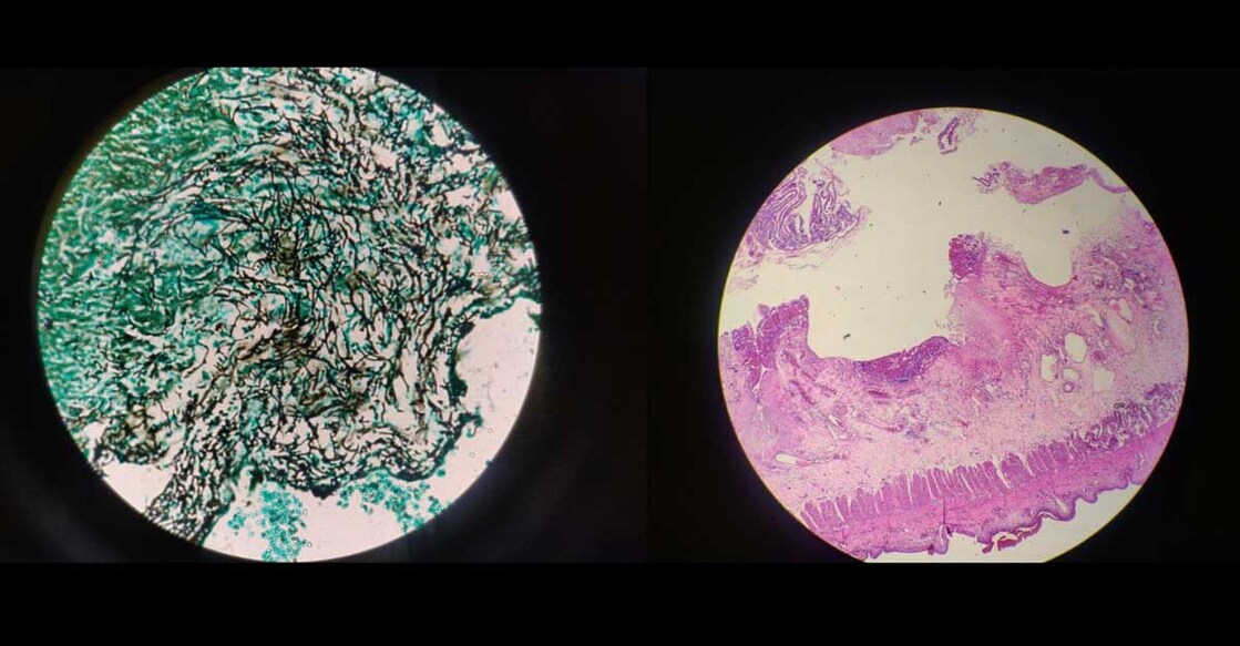 black white fungus test