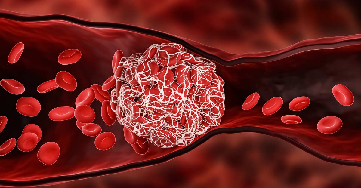 blood clot blood clot