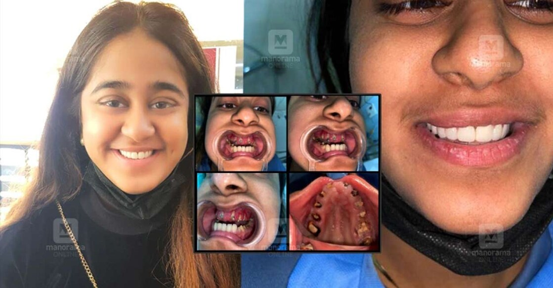 Fathima Rooha blames the decay of her teeth on the excessive use of carbonated drinks.