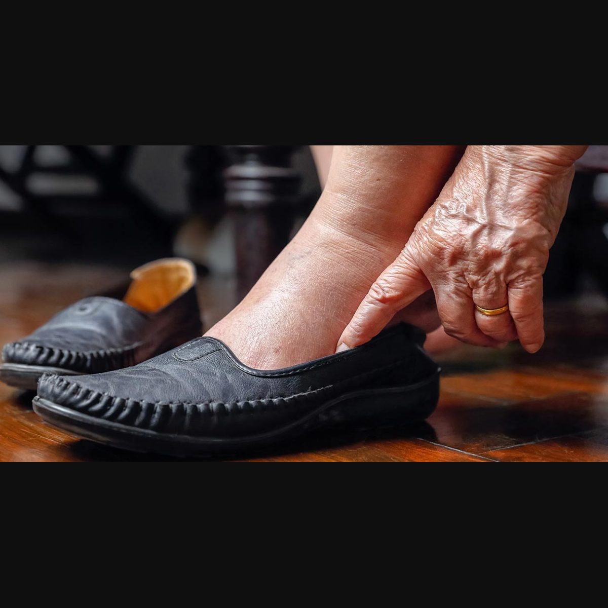 Swollen feet and ankles in elderly