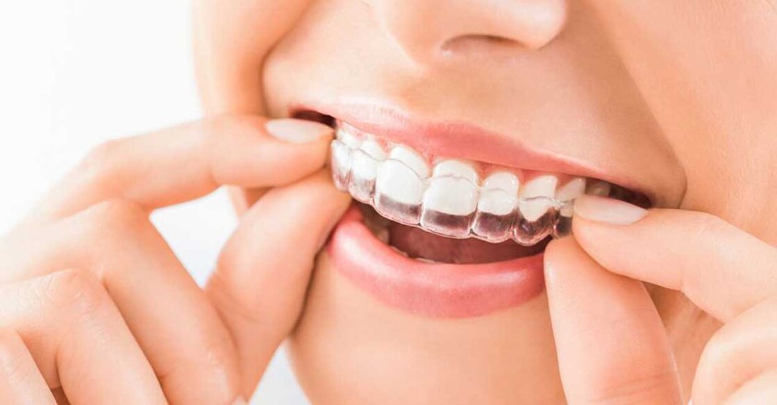 Representative image for transparent teeth aligners. Photo: scyther5/ iStock