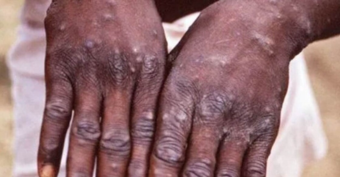 Money pox disease could be detected at a regular laboratory where PCR tests are available. Photo: IANS