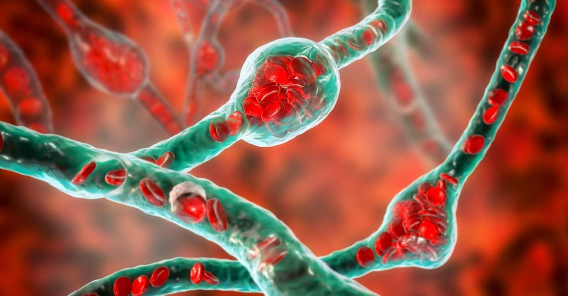 Brain aneurysms are balloon-like bulges in blood vessels in the brain. The condition can sometimes lead to brain hemorrhage. Photo: Dr_Microbe/iStock