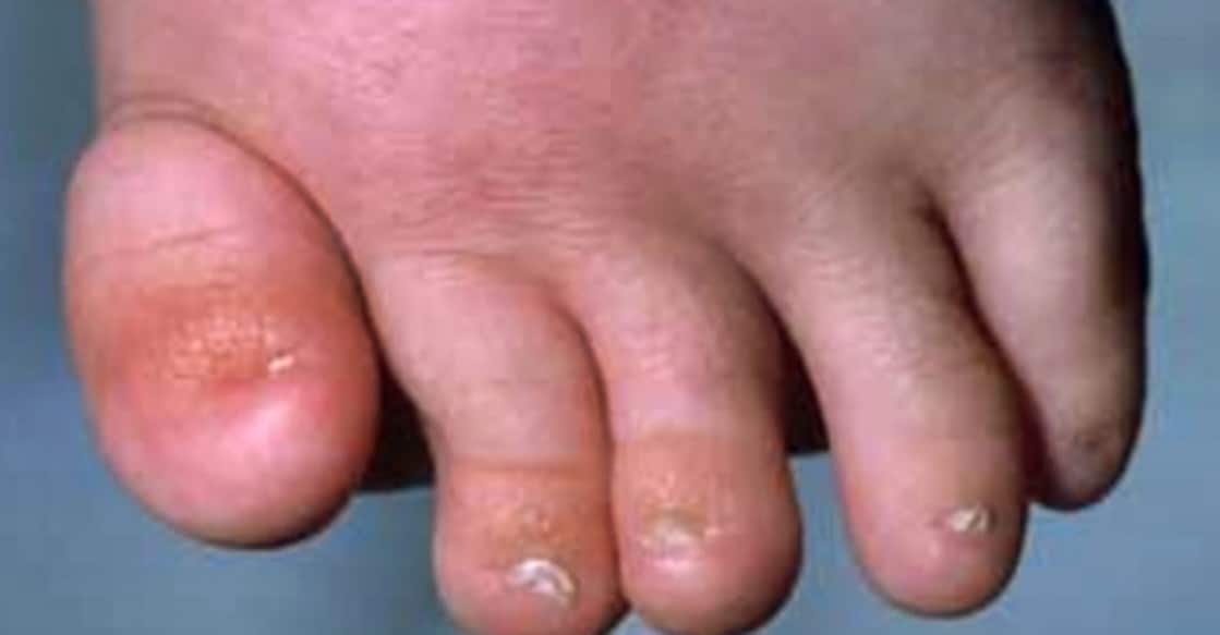 Onychodystrophy (short or absent nails) is a rare hereditary disorder. Representational image: IANS